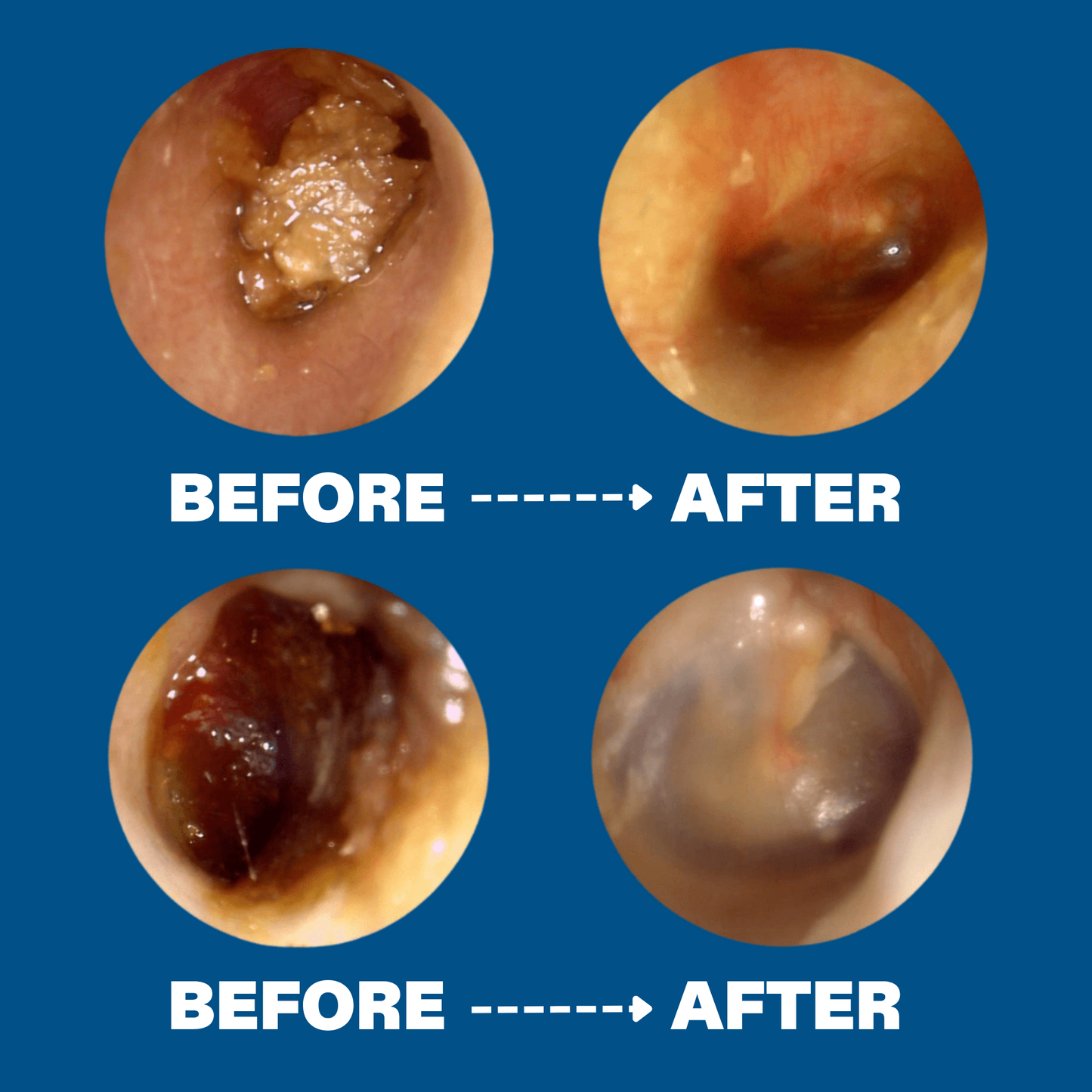 ClearEar™ Earwax Removal Kit