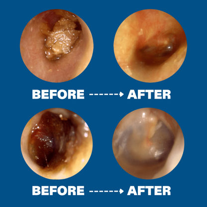 ClearEar™ Earwax Removal Kit